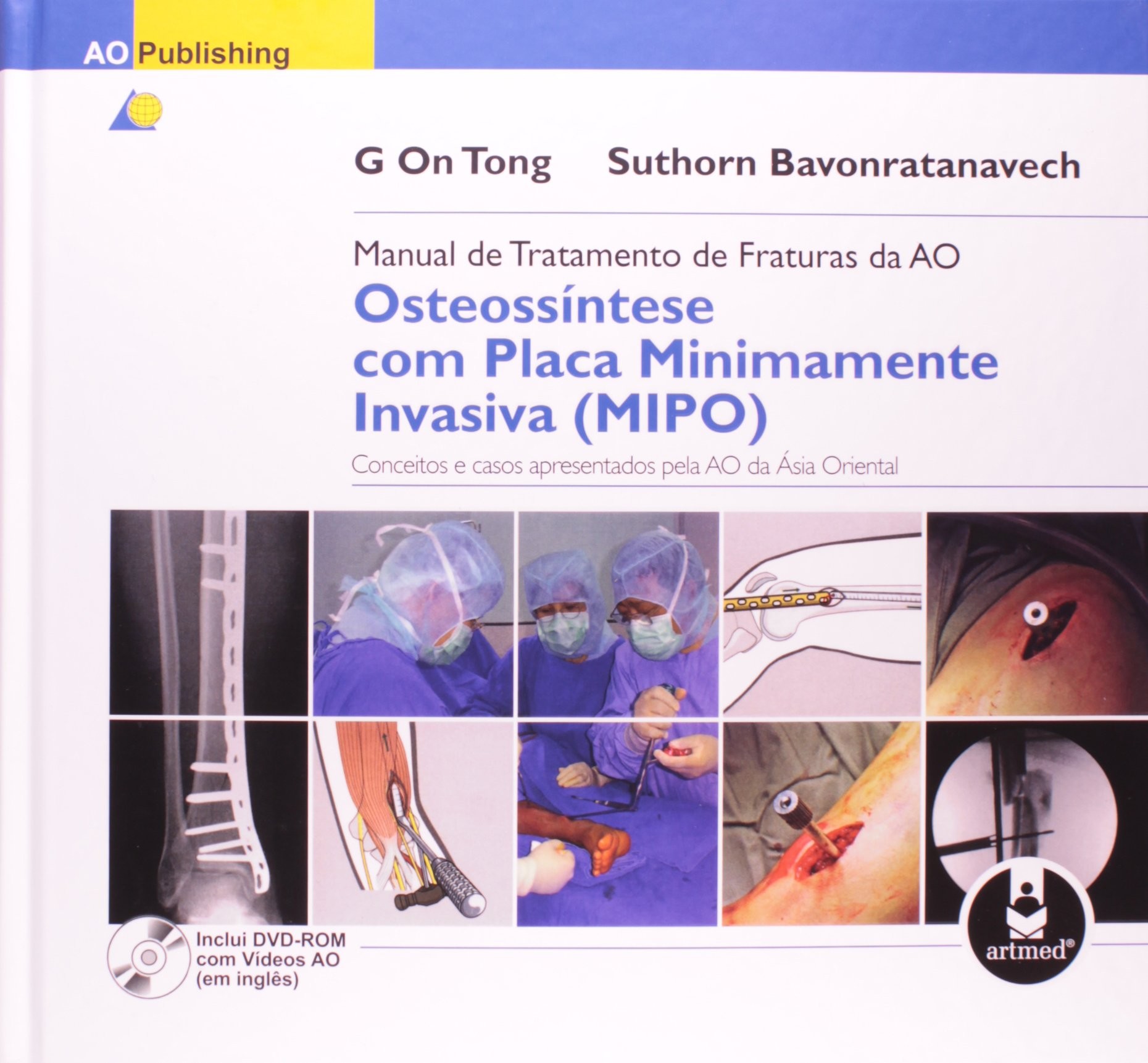 Manual de Tratamento de Fraturas da AO: Osteossíntese com Placa Minimamente Invasiva (MIPO)