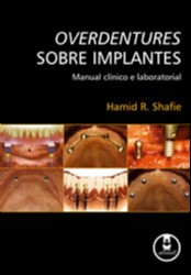 Overdentures Sobre Implantes - Manual Clínico e Laboratorial